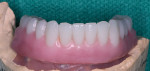 Figure 4  A view of the occlusal wax rim to evaluate mandibular tooth arrangement and function.