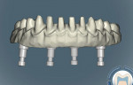 Figure 7  The zirconia substructure was designed using CAD technology.