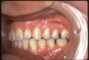 Fig 3. Pressure Pot used in denture repair must be disinfected.