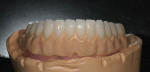 Figure 11  Restorations were seated, and the final hand-waxing of the tissue architecture was completed.