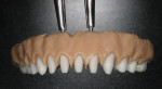 Figure 12  IPS e.max crowns were removed.