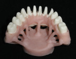 Figure 13  The case was sprued, invested, and pressed with IPS e.max gingiva 3.