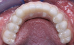 Figure 18  The final seated restorations.