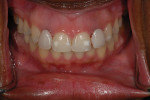 Figure 2  The retracted photograph shows the discrepancy in the match of the restoration and the disharmony of the gingival tissue.