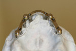 Figure 4  Maxillary attached overdenture, free-shape milled bar with four locators. Note that yellow processing inserts are used rather than black to obtain non-resilient positioning.