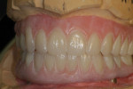 Figure 6  The maxillary and mandibular opposing, full-wrap screw-retained hybrids. Note the white residue from laser scanning procedure.