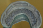 Figure 10  Full facial/occlusal/incisal Sil-Tech silicone matrix for accurately “jumping” teeth from a LC resin basebar to a milled-titanium bar. Note large decisive keys on land area for accurate seating.