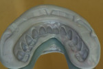 Figure 12  Full facial/occlusal/incisal Sil-Tech silicone matrix for accurately “jumping” teeth from a LC resin basebar to a milled-titanium bar. Note large decisive keys on land area for accurate seating.