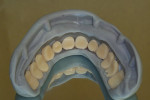 Figure 13  The teeth are seated accurately into matrix with a tight snap fit.