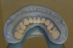 Figure 14  The teeth are seated accurately into matrix with a tight snap fit.