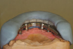 Figure 15  The matrix and teeth are seated on the master cast over bar.