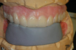 Figure 18  An anterior incisal matrix to ensure exact edge and midline replacement.