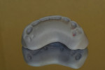 Figure 19  An anterior incisal matrix to ensure exact edge and midline replacement.
