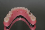 Figure 36  The guide pin is reseated to restore tooth occlusal acrylic to pure tooth shade without any pink; it is then re-milled and re-polished.
