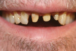 Figure 1  The prosthetic situation before treatment showing the prepared teeth. The previously unattractive appearance was caused by dark discoloration of teeth after endodontic treatment. In addition, there were colored fillings in the anterior area