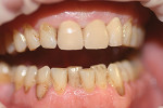 Figure 2  The patient with the laboratory-fabricated provisionals on teeth Nos. 8 through 10 in order to verify the tooth shape, the incisal contour, and the color.