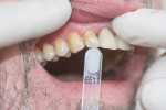 Figure 5  Preparation for ceramic layering. The incisal shade for the transparent incisal area is determined.