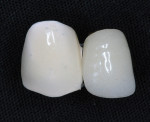 Figure 4  Porcelain facings cemented to gold with zinc phosphate cement.