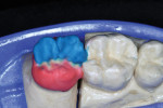 Figure 12  Incisal porcelain was applied to the occlusal/buccal cusps.