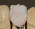 Figure 19  Clear florescence was layered over the top of the enamel.