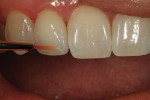 Figure 34  It was decided that white stain was needed to match the decalcification.
