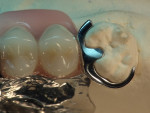 Figure 1  A common laboratory obstacle of a partial-denture repair.