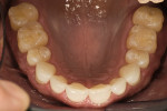 Figure 4  Initial maxillary occlusal view.