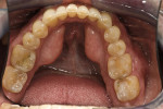 Figure 5  Initial mandibular occlusal view.