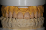 Figure 5  The diagnostic wax-up was fabricated for patient treatment acceptance.