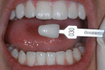Figure 7  The shade of the prototypes and the natural teeth was taken.