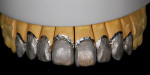 Figure 15  The first foundation bake with translucent porcelains used in the gingival, incisal, and interproximal zones.