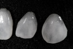 Figure 20  The final veneers showed translucency and opacity of the restorations.