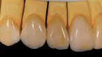 Figure 23  A left lateral view of the veneers.