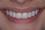 Figure 26  A full-smile view of the veneers at cementation.