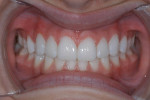 Figure 27  A retracted view of the veneers at cementation.
