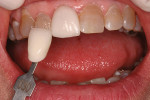 Figure 30  A trial veneer was fabricated and placed in the mouth.