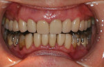 Figure 1  The patient prior to treatment wearing the occlusal splint.