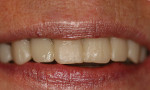 Figure 3  The patient’s teeth were prepared following the diagnostic wax-up provided by the laboratory and the patient was temporized.