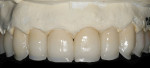 Figure 7  A thin foundation layer followed by an application of blue stains on the incisal edge achieved the illusion of depth or translucency.