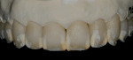 Figure 15  The restorations were stained internally on the distal and mesial using IPS e.max Ceram Opal 1.