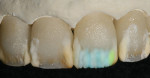 Figure 16  A contrast layer was applied using IPS e.max Ceram Incisal 1 and Incisal 3.