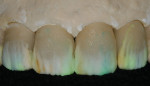 Figure 17  A contrast layer was applied using IPS e.max Ceram Incisal 1 and Incisal 3.