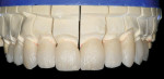 Figure 19  The fired crowns were seated on the trimmed model to evaluate contour and incisal characterizations.