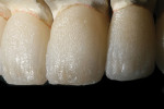Figure 20  The fired crowns were seated on the trimmed model to evaluate contour and incisal characterizations.