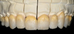 Figure 22  A mixture of 50% Opal 5 and transparent neutral were applied to create a warm translucent effect in the gingival.