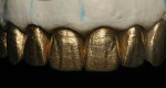 Figure 35  Highlight gold powder was applied to the restorations to evaluate final detailing.