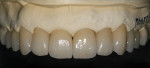 Figure 37  The final internal effect of the incisal edges.