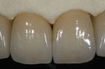 Figure 38  The final internal effect of the incisal edges.