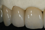 Figure 39  The final internal effect of the incisal edges.