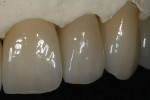 Figure 40  The final internal effect of the incisal edges.